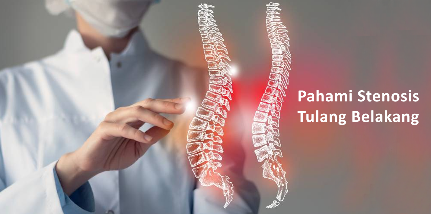Pahami Stenosis Tulang Belakang, Ini Dia Penyebab dan Penanganannya Pahami Stenosis Tulang Belakang, Ini Dia Penyebab dan Penanganannya